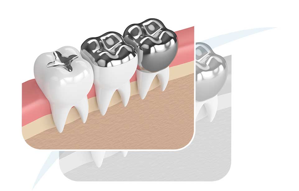 Amalgam Fillings | North Main Family Dental | Family and General Dentist | Airdrie