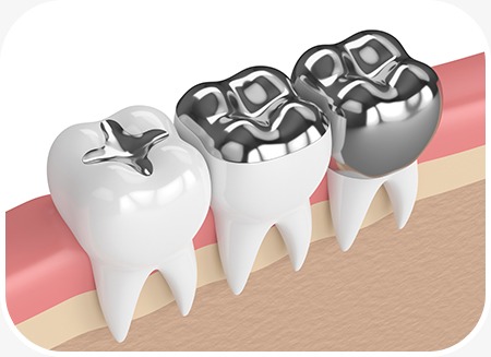 Amalgam Fillings | North Main Family Dental | Family and General Dentist | Airdrie
