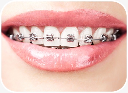 Dental Braces | North Main Family Dental | Family and General Dentist | Airdrie