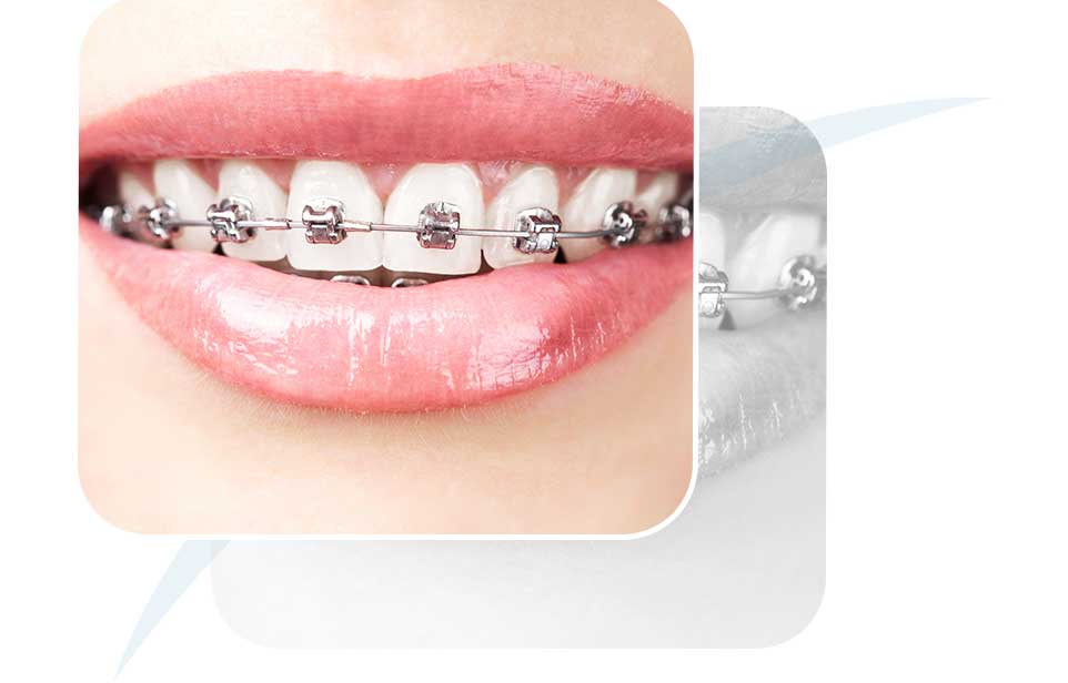 Dental Braces | North Main Family Dental | Family and General Dentist | Airdrie