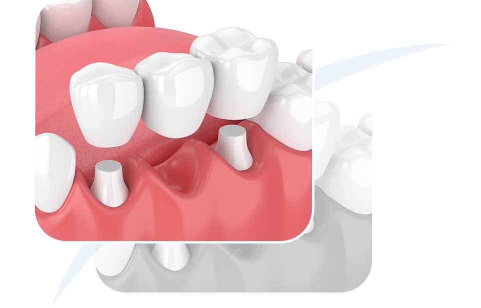Dental Bridges | North Main Family Dental | Family and General Dentist | Airdrie