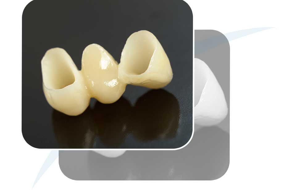 Dental Bridges | North Main Family Dental | Family and General Dentist | Airdrie