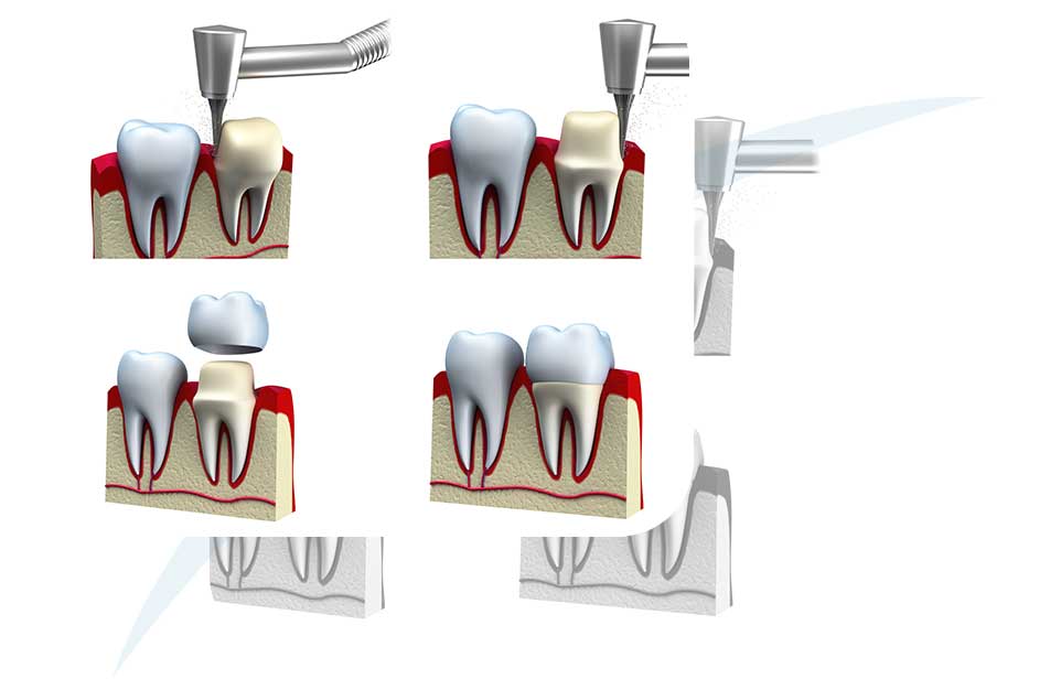 Dental Crowns | North Main Family Dental | Family and General Dentist | Airdrie