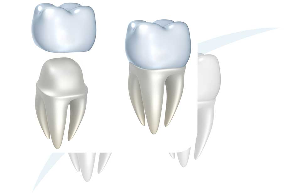 Dental Crowns | North Main Family Dental | Family and General Dentist | Airdrie