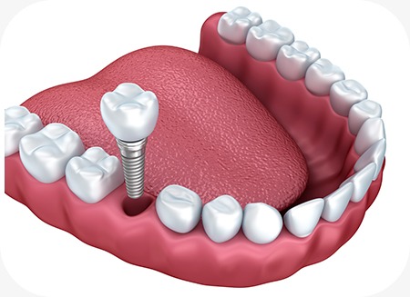 Dental Implants | North Main Family Dental | Family and General Dentist | Airdrie