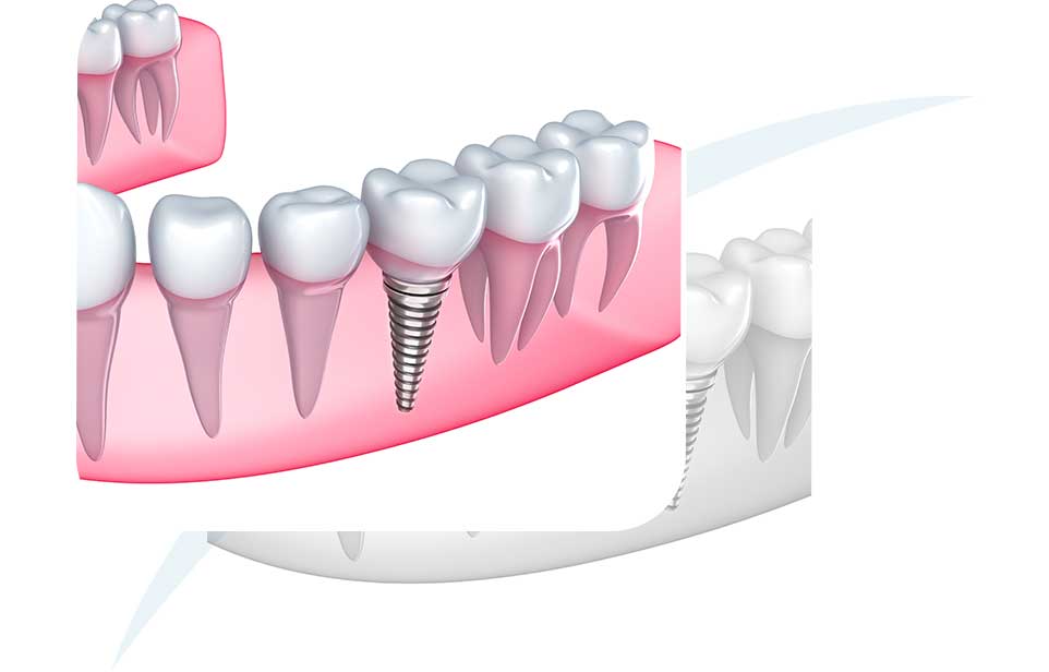 Dental Implants | North Main Family Dental | Family and General Dentist | Airdrie