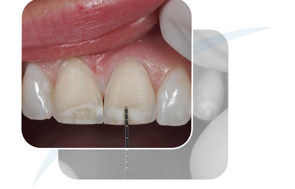 Icon Resin Infiltration | North Main Family Dental | Family and General Dentist | Airdrie