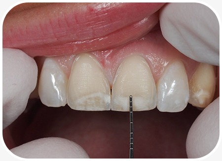 Icon Resin Infiltration | North Main Family Dental | Family and General Dentist | Airdrie