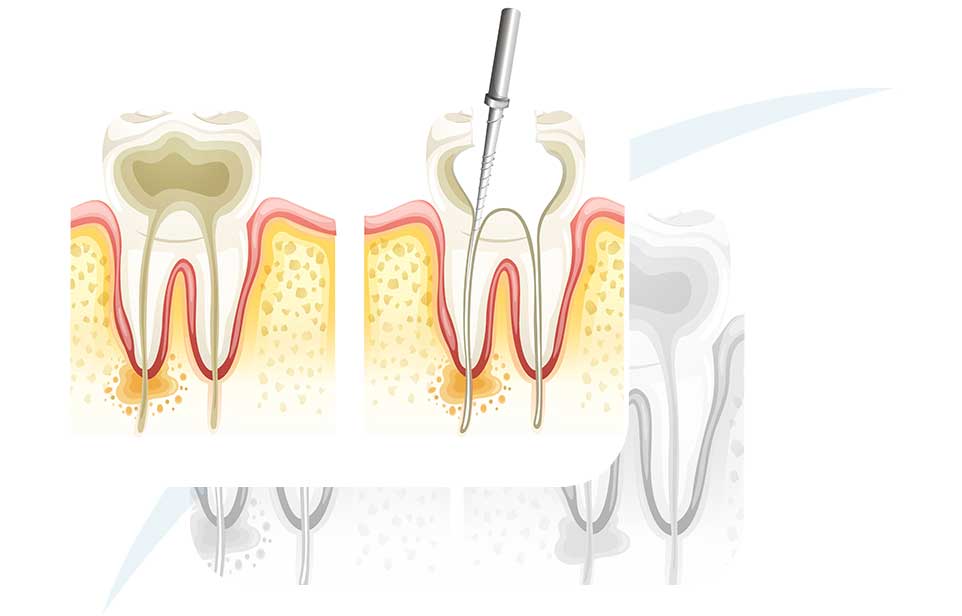 Root Canal Therapy | North Main Family Dental | Family and General Dentist | Airdrie