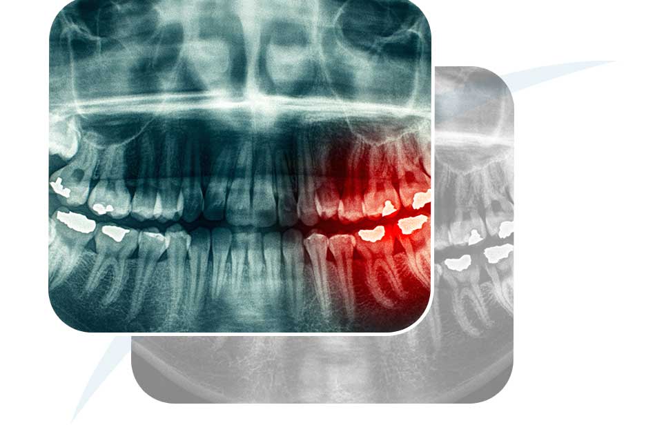 Wisdom Teeth Extraction | North Main Family Dental | Family and General Dentist | Airdrie