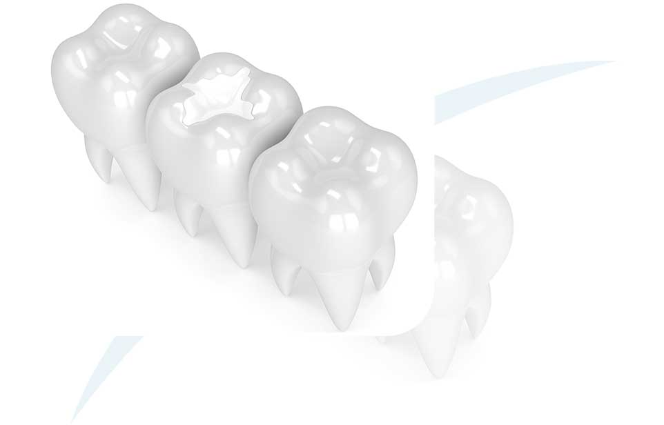 White Fillings | North Main Family Dental | Family and General Dentist | Airdrie