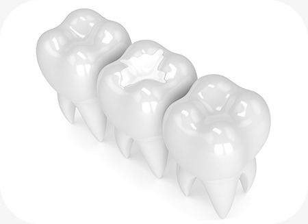 White Fillings | North Main Family Dental | Family and General Dentist | Airdrie